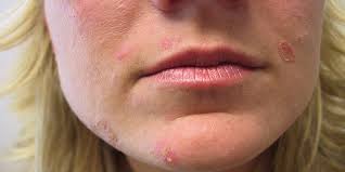 Impetigo Nedir?